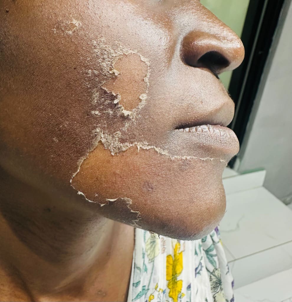 Facial Treatment - Skin Resurfacing